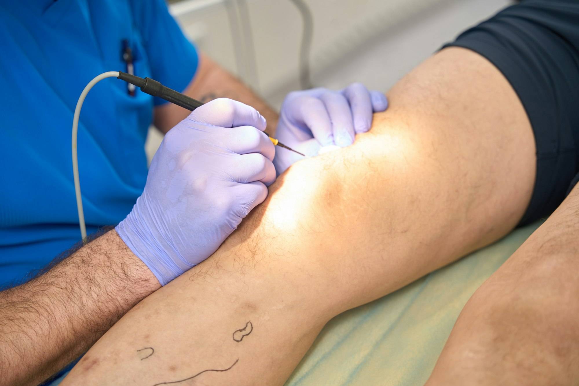 Vein Treatment Services in Queens NY