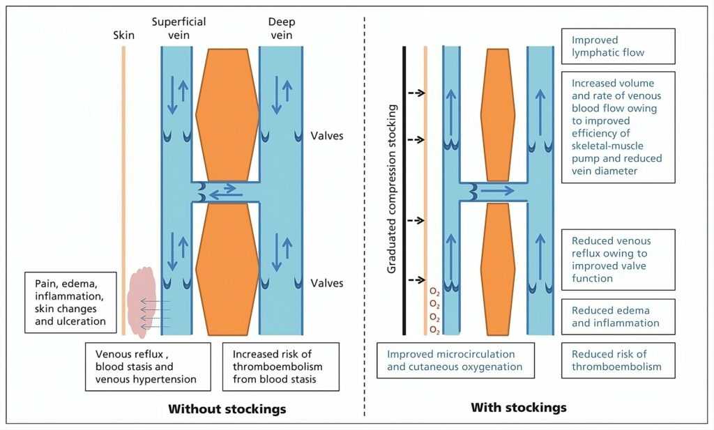 Compression Therapy Chart