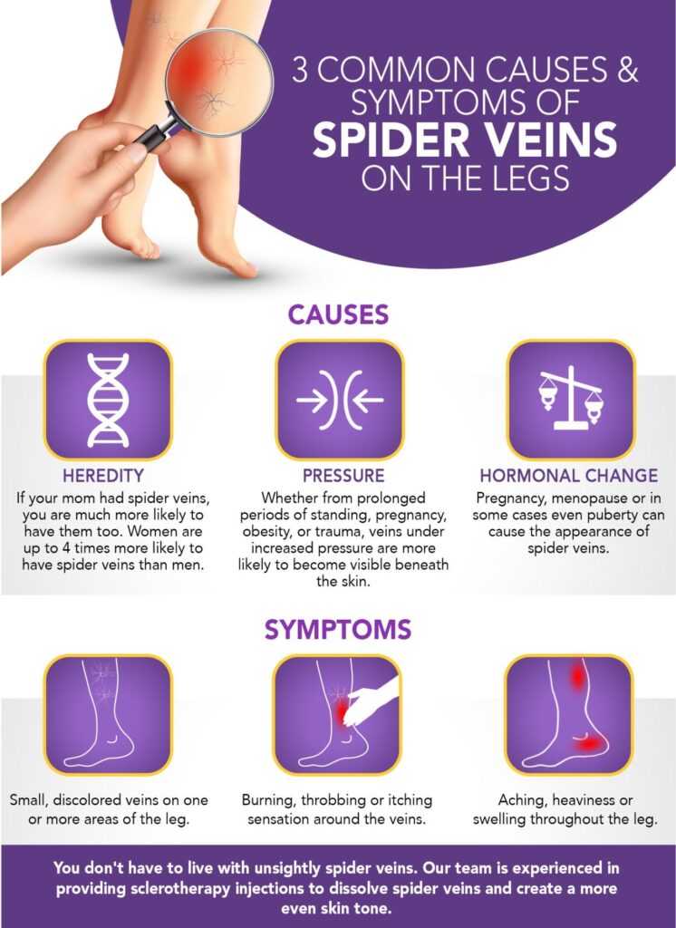 Spider Vein Treatment in Queens NY