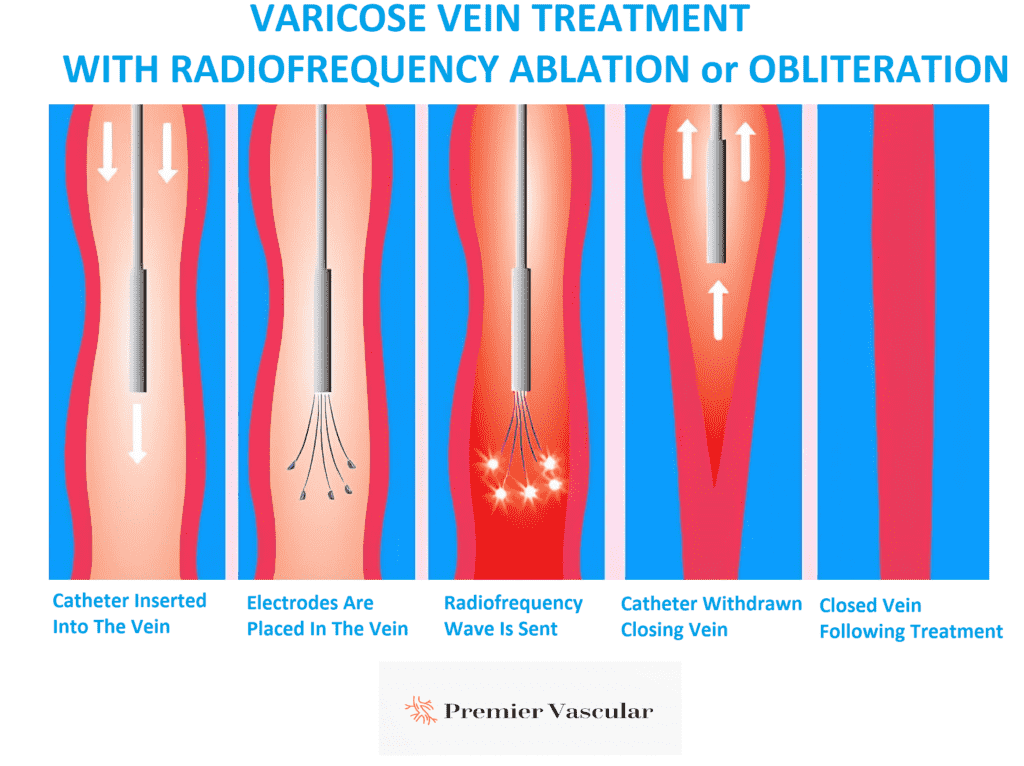 Radiofrequency-Ablation-for-Varicose-Veins-Treatment