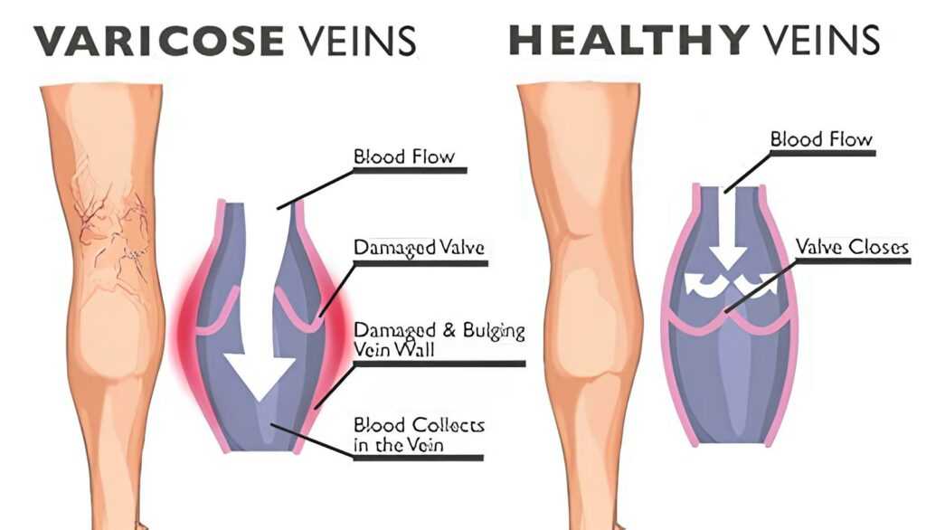 Varicose Veins Diagram