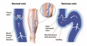 minimally invasive vein treatments